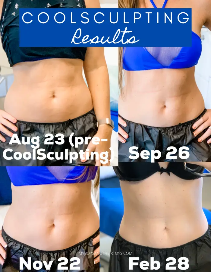 5 CoolSculpting Before-and-After Stories (And How to Get the Same Results)